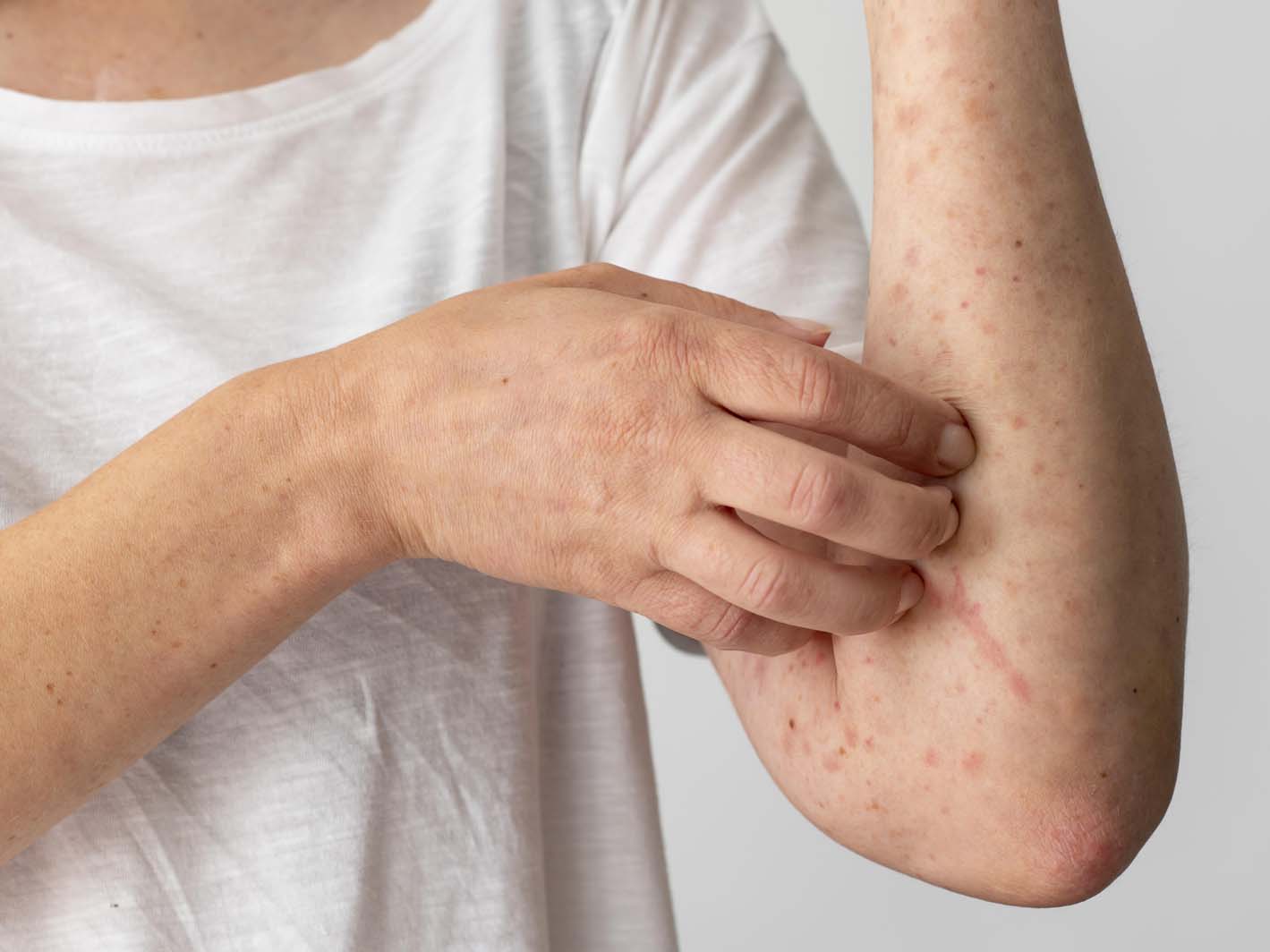 Impetigo a všetko čo potrebujete vedieť Fakultná nemocnica s