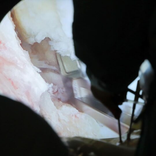 Neurochirurgovia z Nových Zámkov ako prví na Slovensku operovali chrbticu novou biportálnou endoskopiou